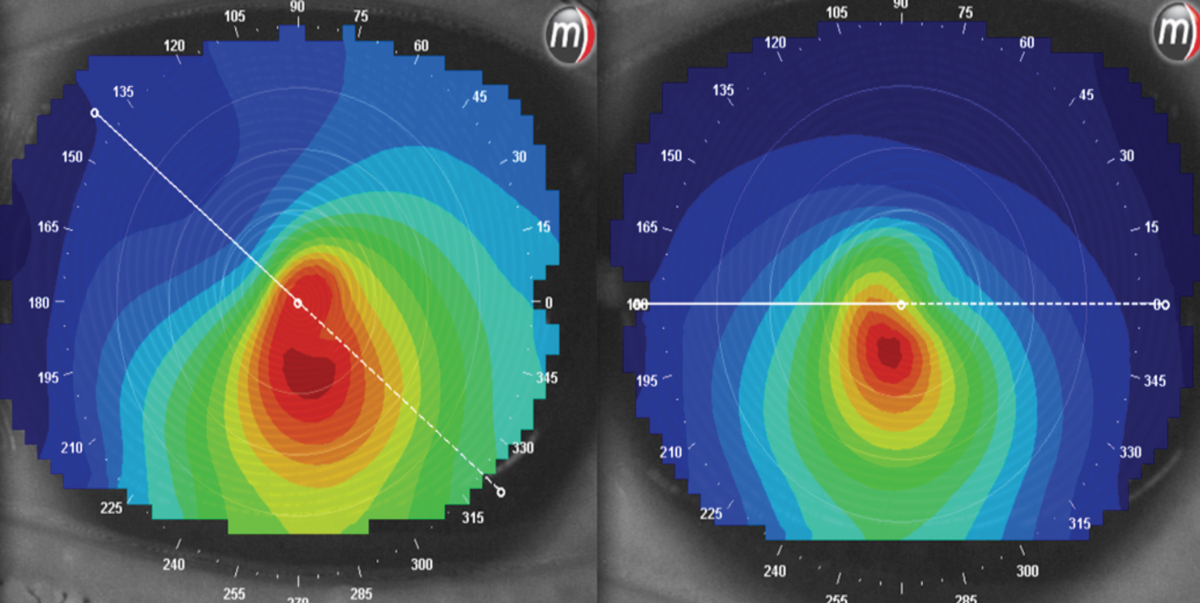 At left, a patient is looking off center when this image was taken. The right images were taken while looking straight ahead. The patterns are very different between the two.