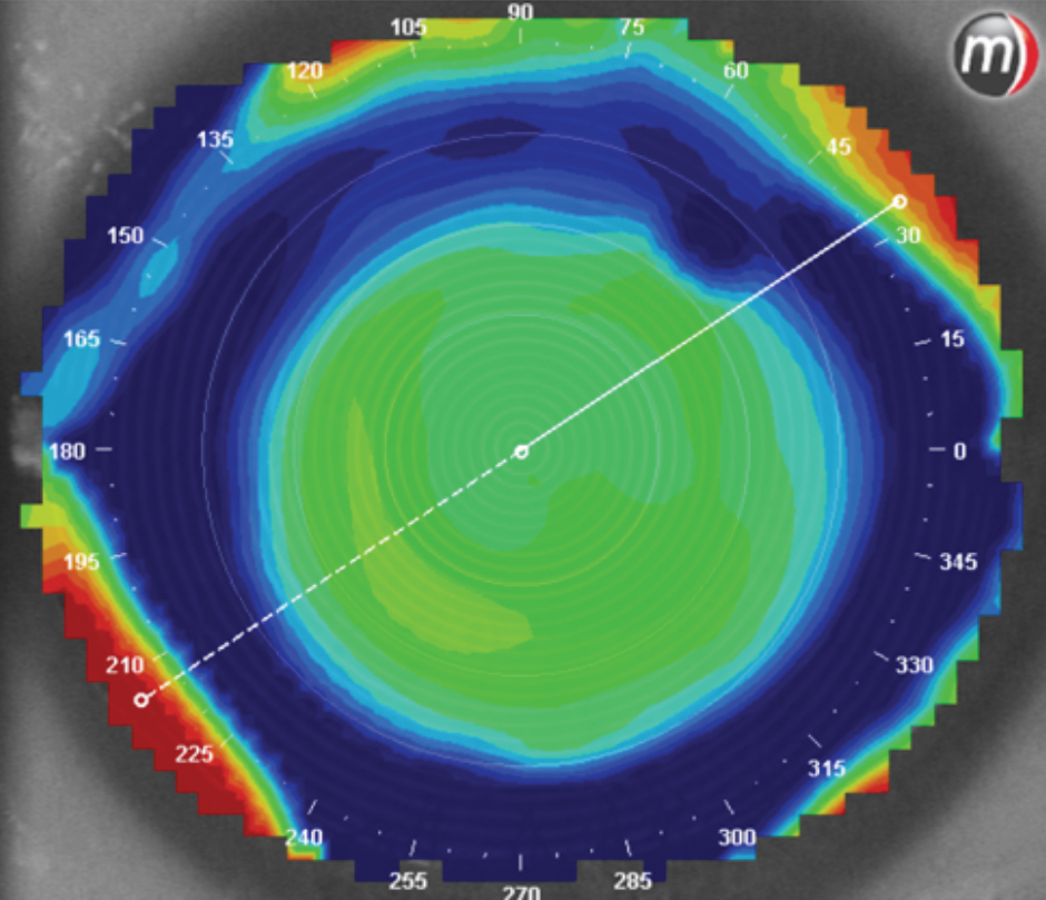 A patient with normal corneas who overwore their soft one-day disposable lenses caused a compression right on their peripheral cornea, as seen on a tangential map.