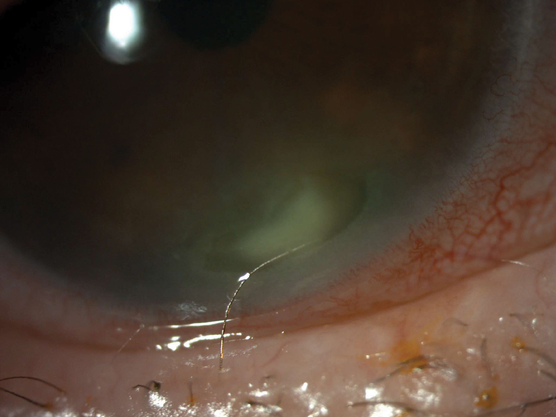 Patient at initial presentation with a corneal ulcer and one distinct lash (trichiasis).