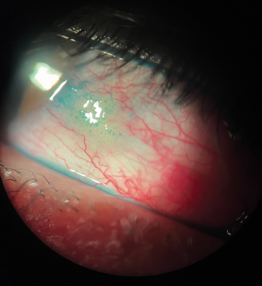 Fig. 1. Redness seen in ocular allergy. This patient also had a pinguecula and lissamine green staining.
