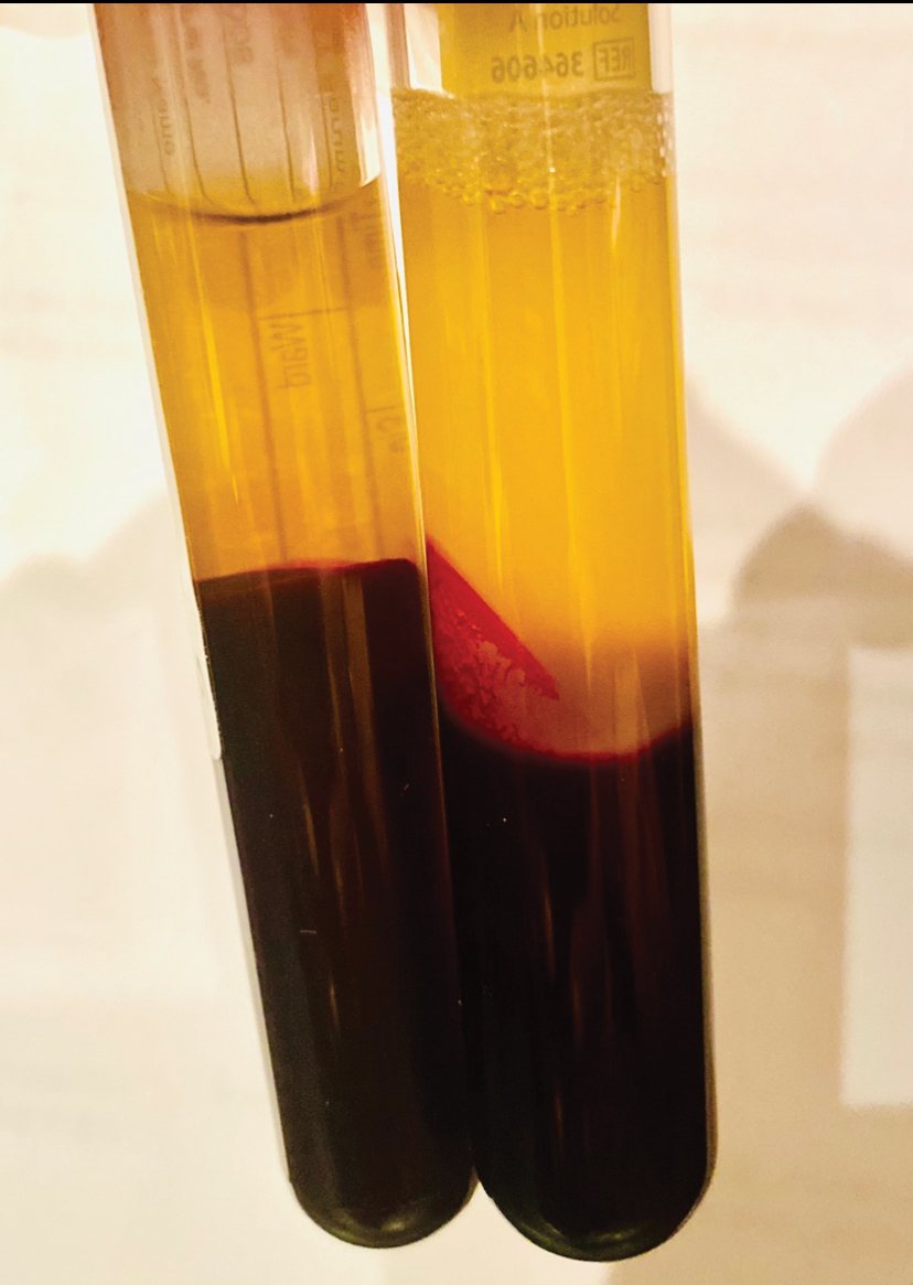 Fig. 3. View of autologous serum on left and platelet rich plasma on the right.