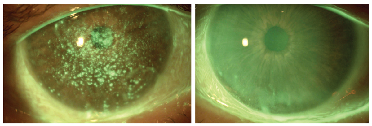 Fig. 4. Resolution of persistent epithelial defects with PRP and lid hygiene for three months. 