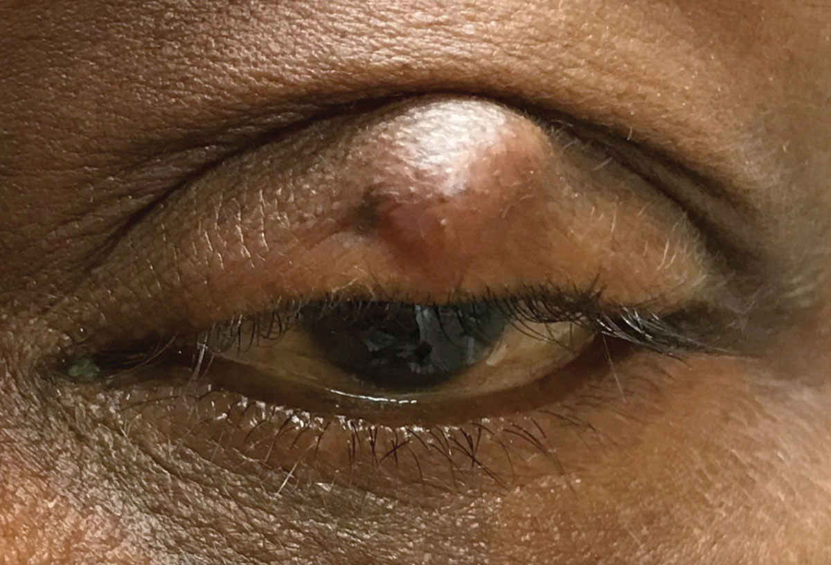 A dry eye patient cohort treated with rhNGF eye drops experienced significant symptom improvement. Researchers believe it could be a promising therapy.