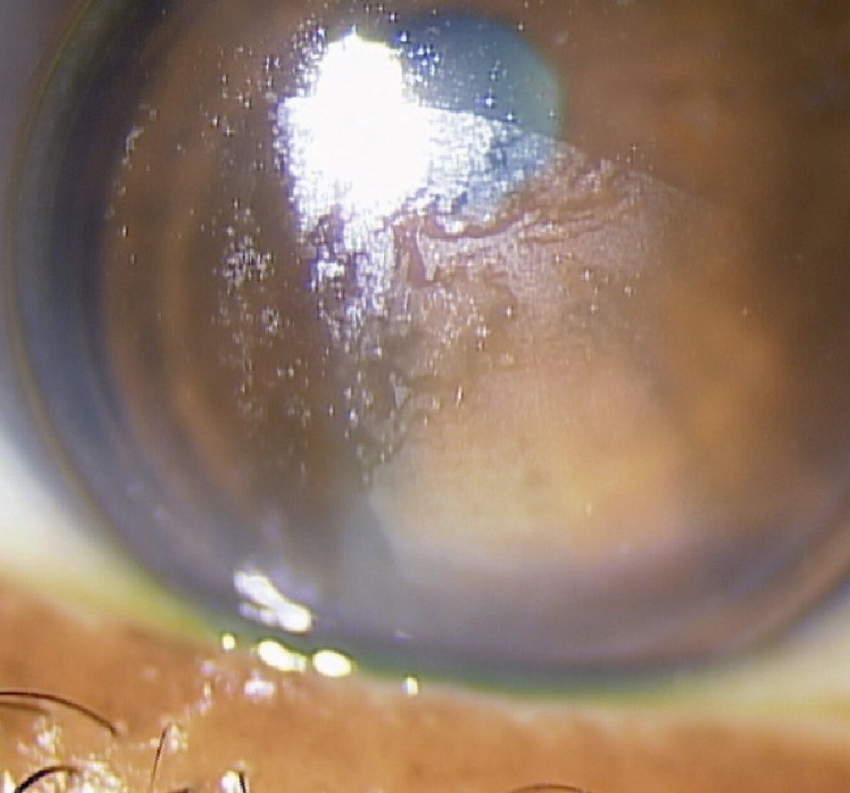 Fig. 1. Corneal lens with acquired mucoprotein film on the anterior lens surface in case one patient. Her incomplete blink pattern is evident, as the upper third of the lens is more clear.