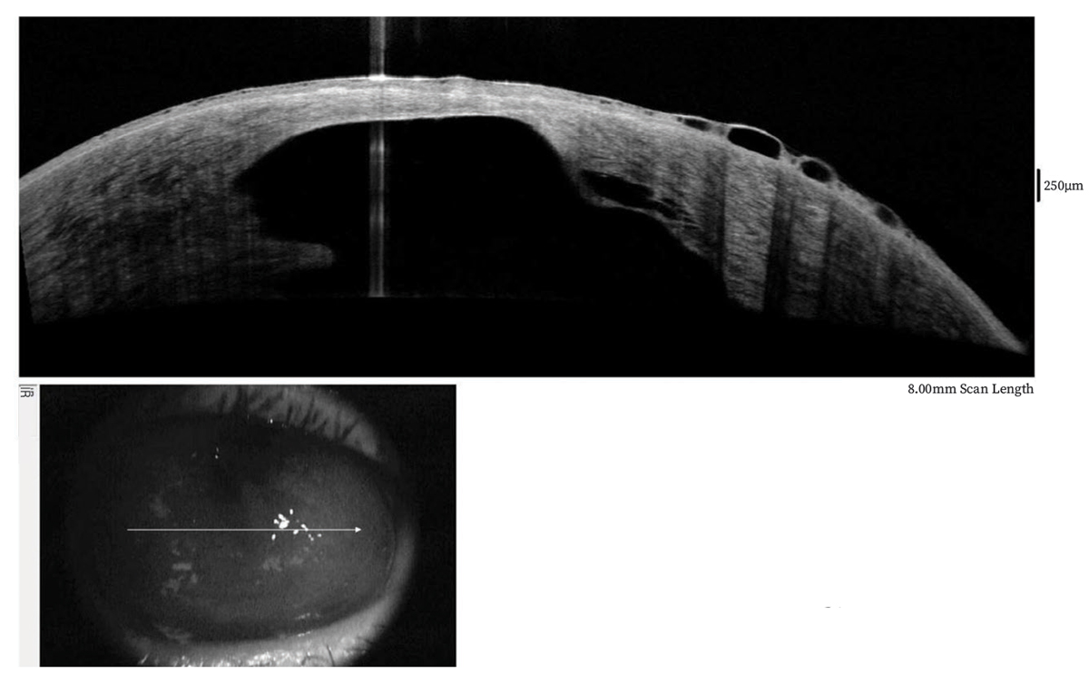 Fig. 1. OCT was taken three weeks after initial loss of acuity. Note surface epithelial edema/bullae and large posterior corneal defect with irregular contour. A water cleft separates the posterior stroma from Descemet’s membrane.