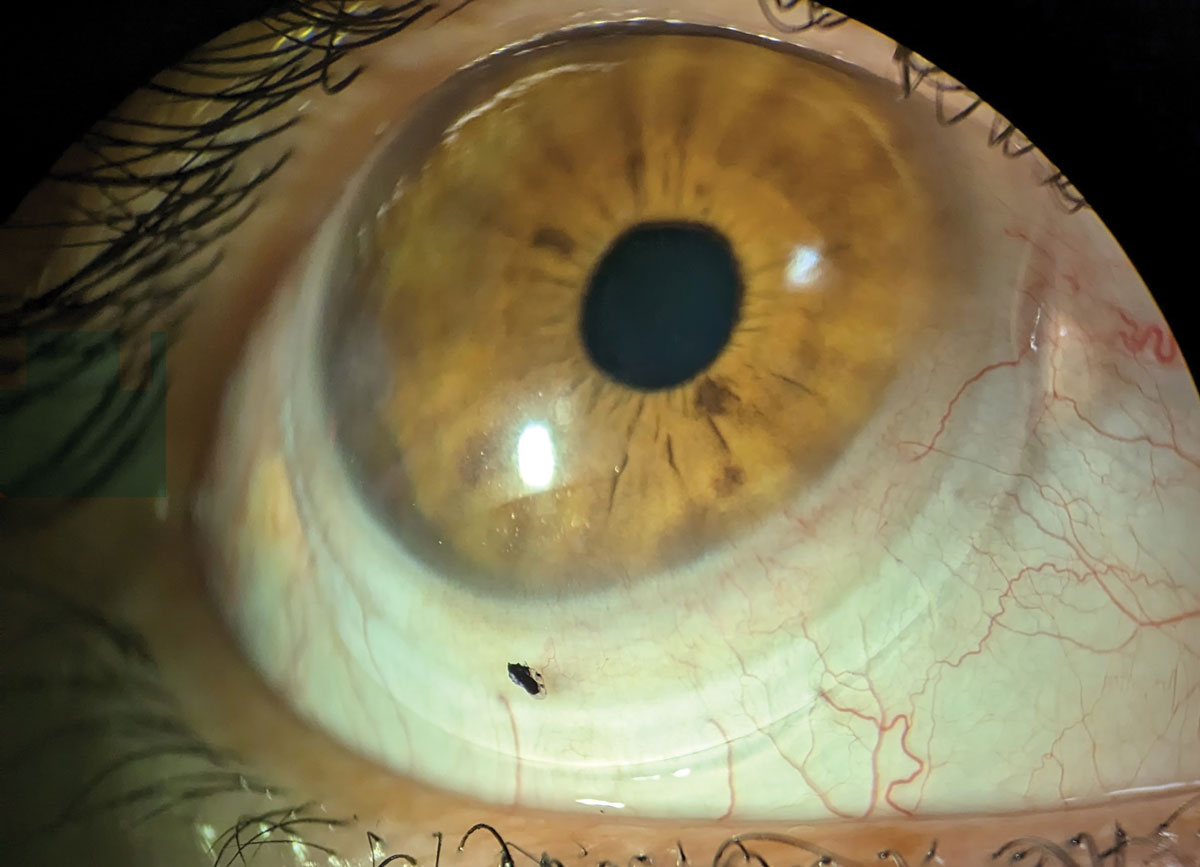 Fig. 4. Right scleral lens after completion of the notching process. Note the nasal recess allowing for less compression near the pinguecula.