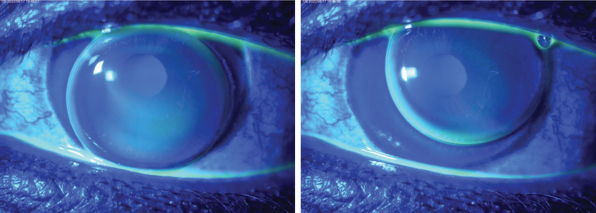 Fig. 2. Assessing this aphakic GP lens was more challenging because the dynamic fit meant it was lid-attached on one blink and interpalpebral on the next blink.