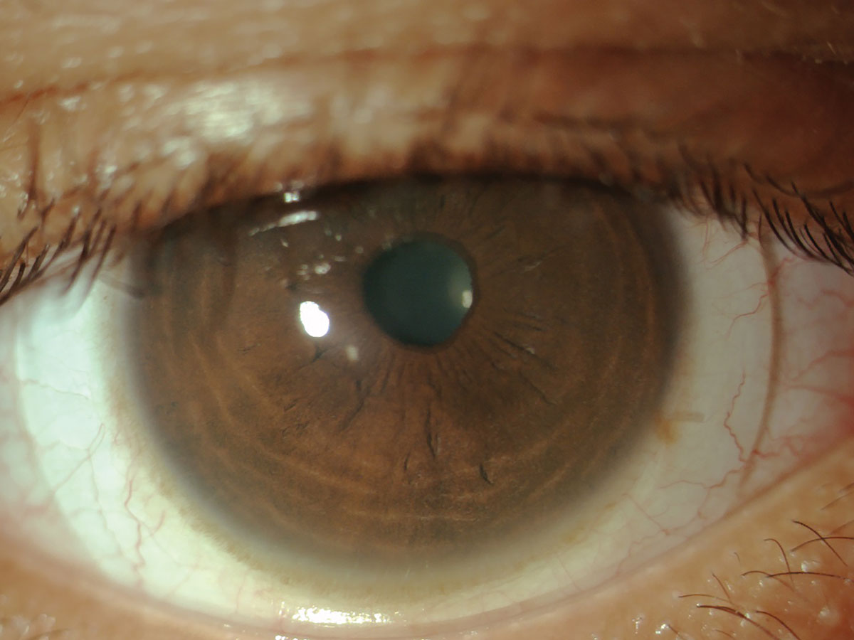 Fig. 3. In this scleral fit, it was helpful to note that the markings were at the 4 and 10 o’clock position.