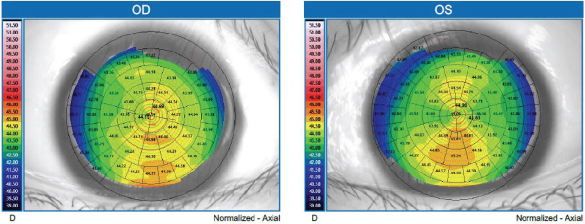 Fig. 1. Topography of the patient’s right and left eyes.