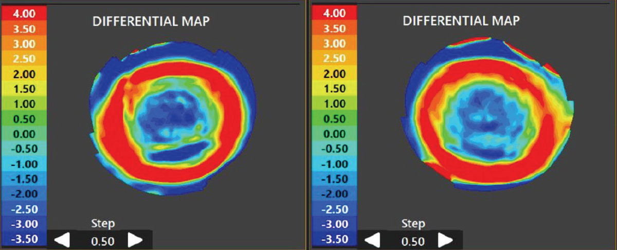 Fig. 2. Comparison map of pre- and post-wear topography scan, highlighting the change in corneal shape caused by ortho-K.