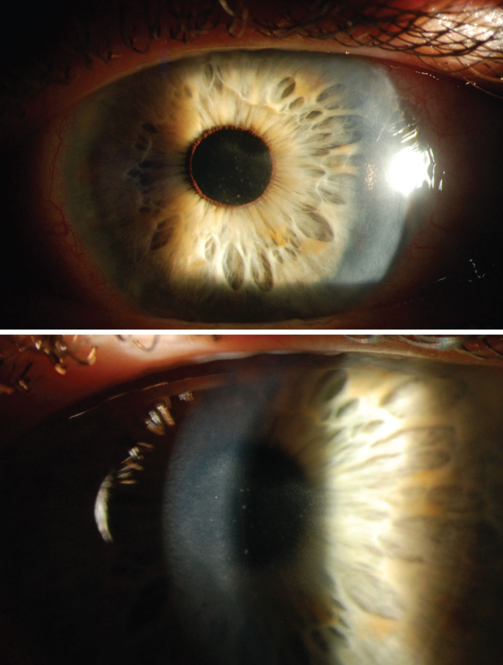 The patient presenting with nummular stromal keratitis caused by HZO.