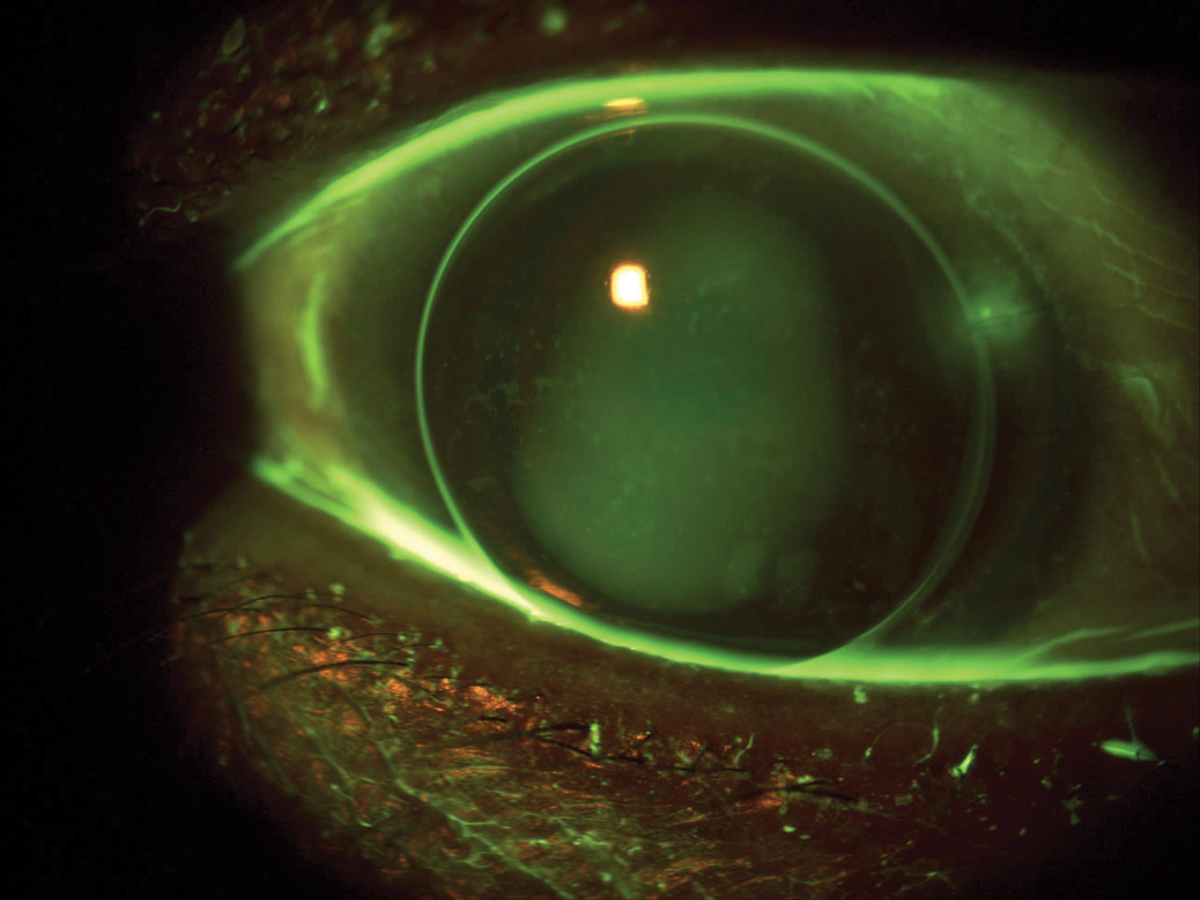 Fig. 1. Corneal lens on eye with nasal embedded corneal suture showing staining. Overall fit was steep, so the lens was reordered with a smaller diameter to improve fit and avoid the suture.