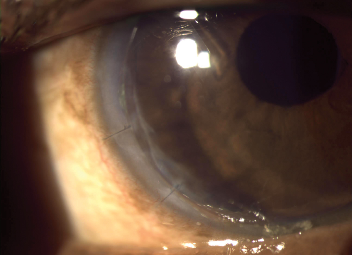 Fig. 2. The smaller overall diameter also helped avoid staining at the inferotemporal embedded sutures in Case #1.