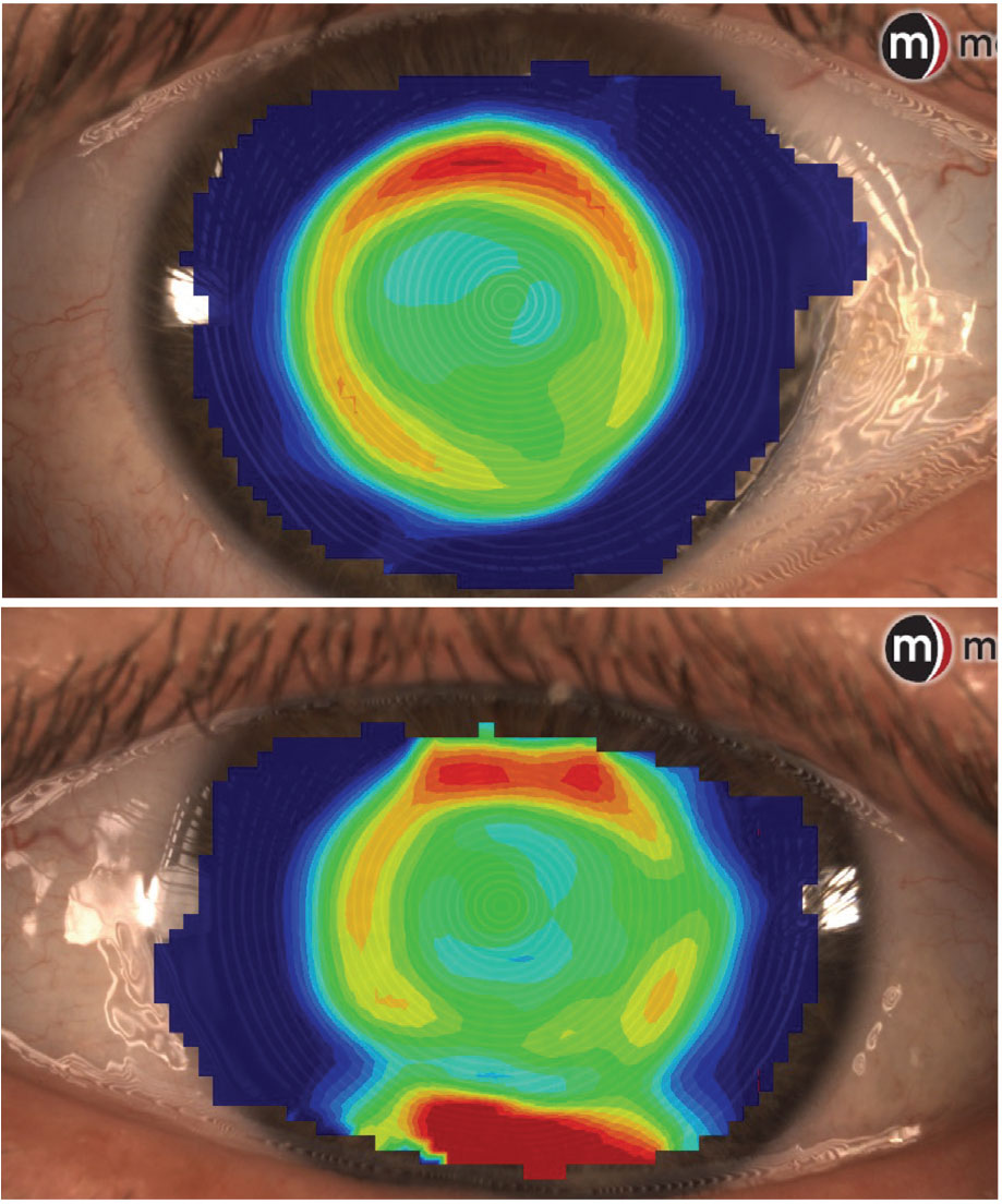 Topography of the right and left eye after skipping ortho-K wear for three nights; note the light but well-centered treatment pattern.