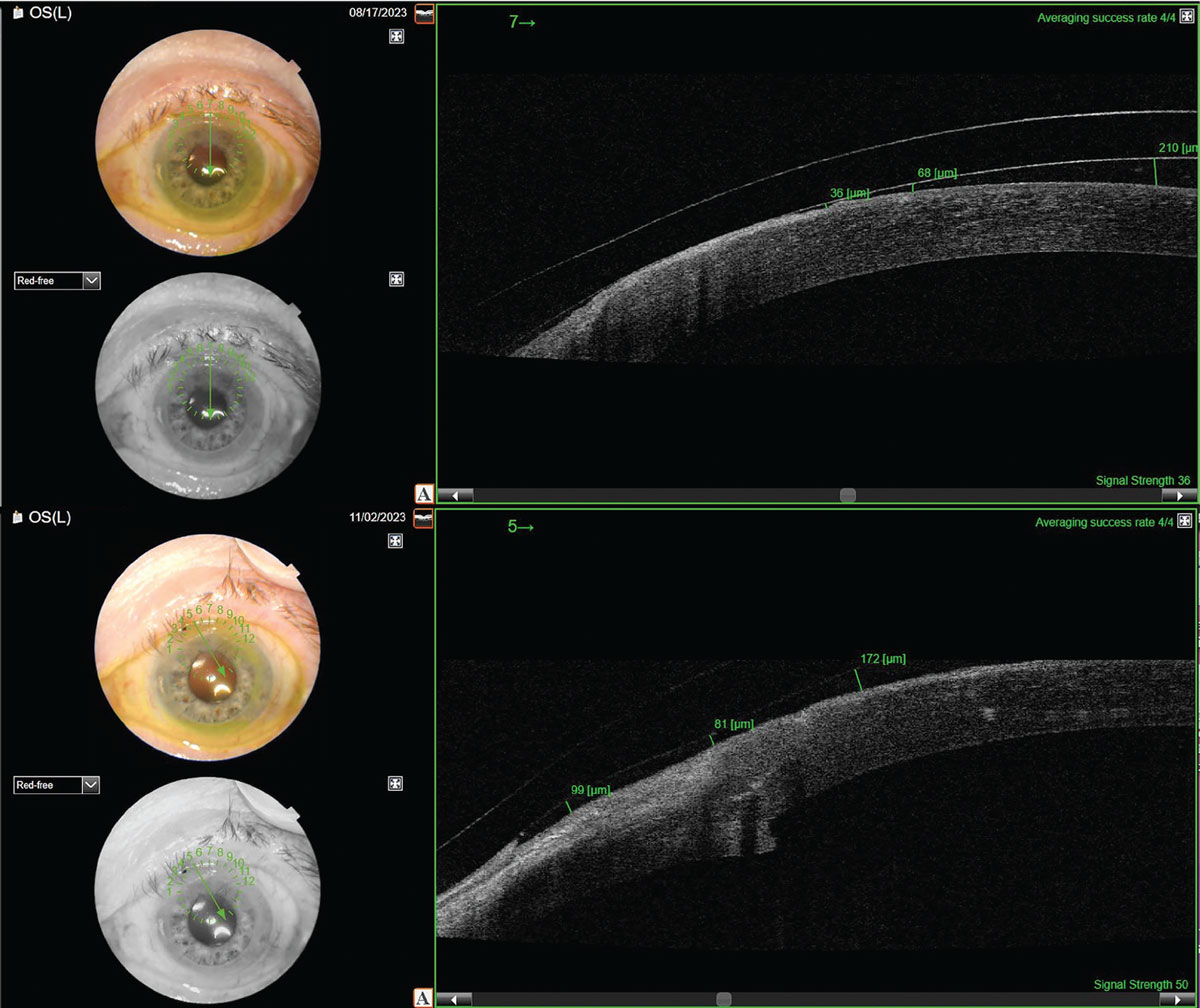 The top image depicts a lens that is much too large for the eye, causing inferior decentration and superior corneal touch. This patient felt discomfort after three to four hours of wear (the exact time the lens would have settled down to touch the cornea). The bottom image displays a smaller version of a scleral lens over the same eye. This lens is vaulting over the superior cornea and is not touching.