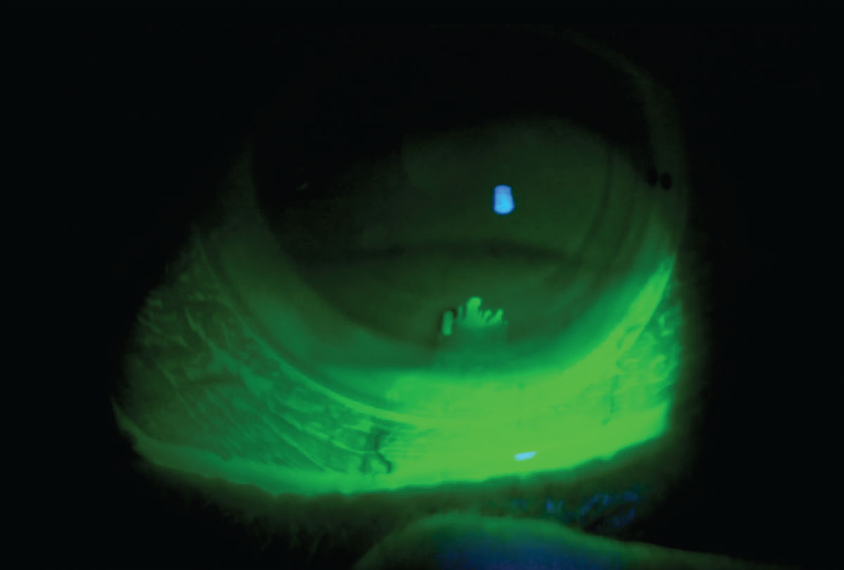 Here, fluorescein is put over the lens during a follow-up examination. This patient was complaining of midday fogging, but when I inserted the fluorescein initially, there was no uptake. I gently added some pressure with the lid to the bottom of the lens and fluorescein went into the lens easily. Here, I could tell that the vertical meridian of the peripheral curves needed some steepening. After this adjustment, the midday fogging decreased.