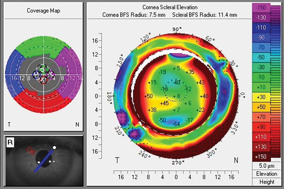 xFig. 1. CSP scan of keratoconic eye with marked scleral asymmetry, note scleral principal meridians do not follow corneal toricity.