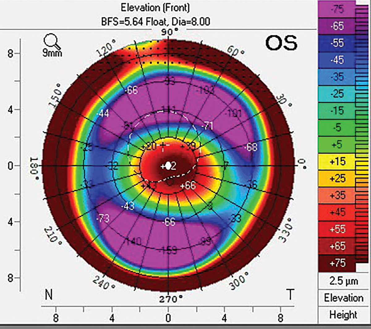 Fig. 2. Pentacam front elevation scan of keratoconic cornea with marked elevational differences along horizontal and vertical meridians.