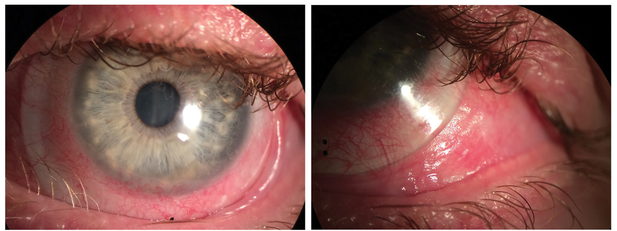 Fig. 3. Scleral lenses in setting of OCP. Note the presence of trichiasis and symblepharon and conjunctival keratinization.