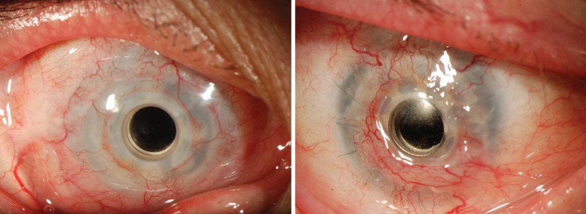 The KPro prosthesis as it looks in the eye.