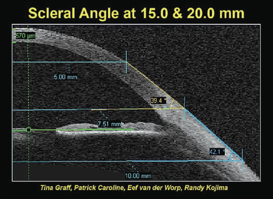 Fig. 2. Scleral angle variability among 15.0mm vs. 20.0mm chord lengths.