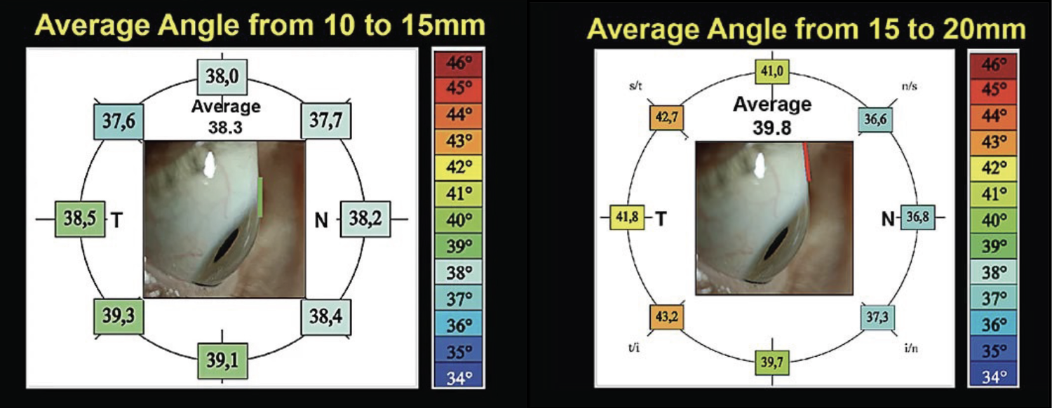 Fig. 3. Among the 15mm chord, scleral angles showed very little variation (left). When compared, the 20.0mm chord showed much more scleral angle variability (right). 