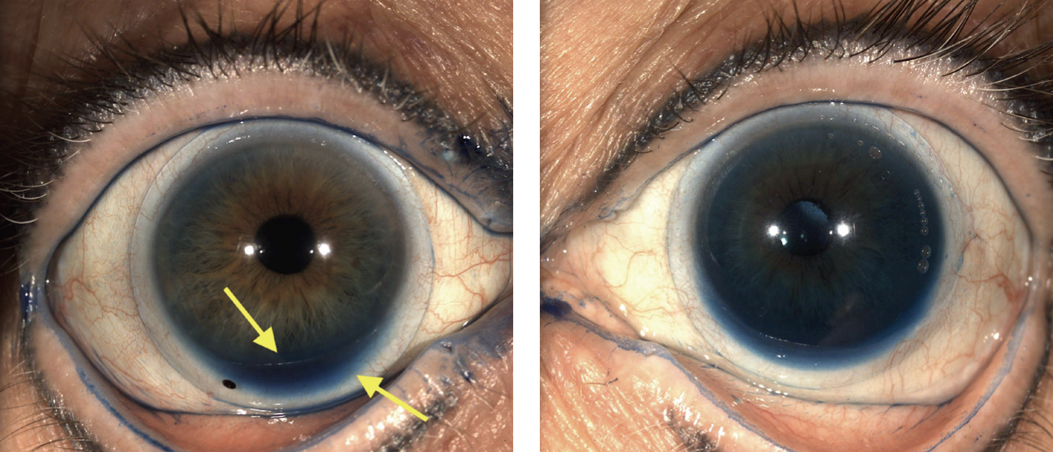 Fig. 5. (Left) Notice the mild accumulation of lissamine green inferiorly along the limbus. Fig. 6. (Right) Notice the large amount of LG throughout, causing the iris to be artificially more blue/green. 