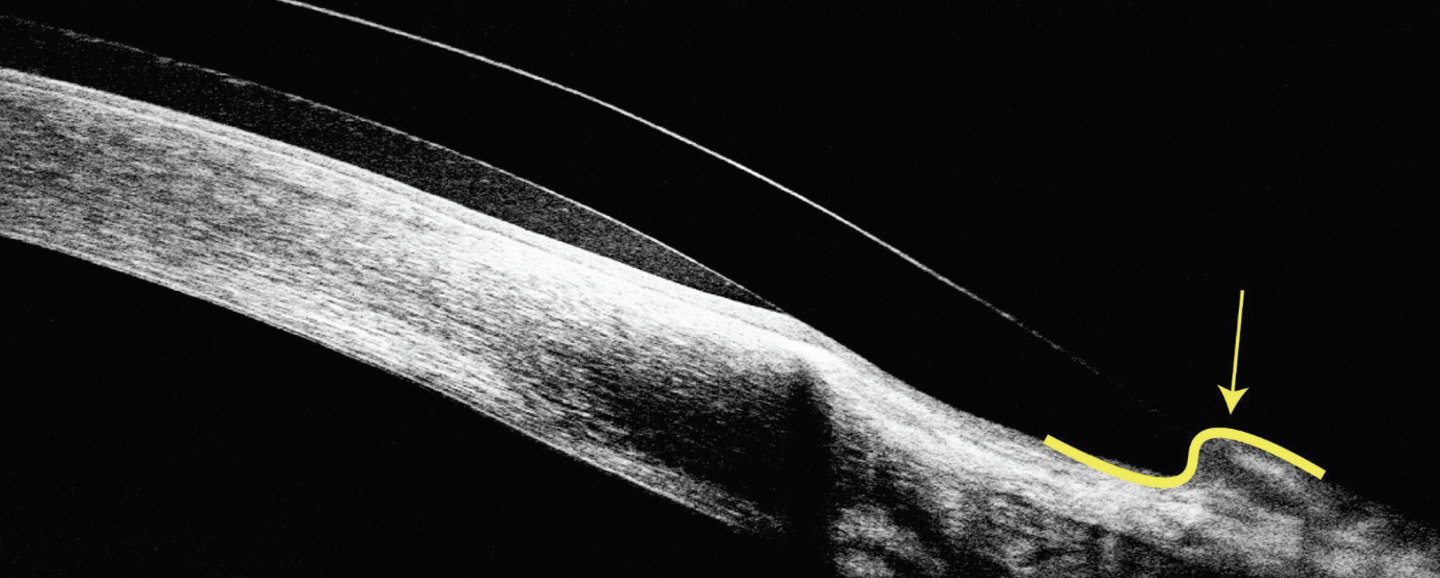 Fig. 7. This steep peripheral curve has caused the conjunctiva to start riding over the anterior surface of scleral lens.