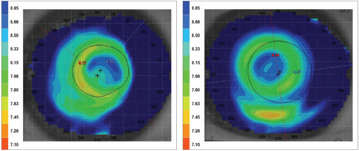 Fig. 1. Over topography of the patient’s right eye before (right) and after (left) moving the multifocal position.