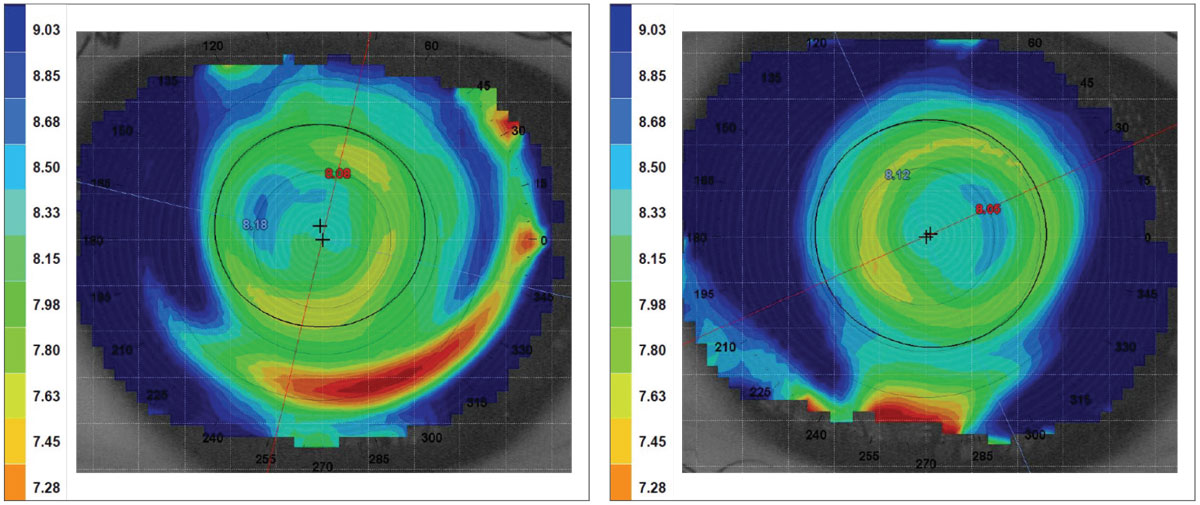 Fig. 2. Over topography of the patient’s left eye before (right) and after (left) moving the multifocal position.