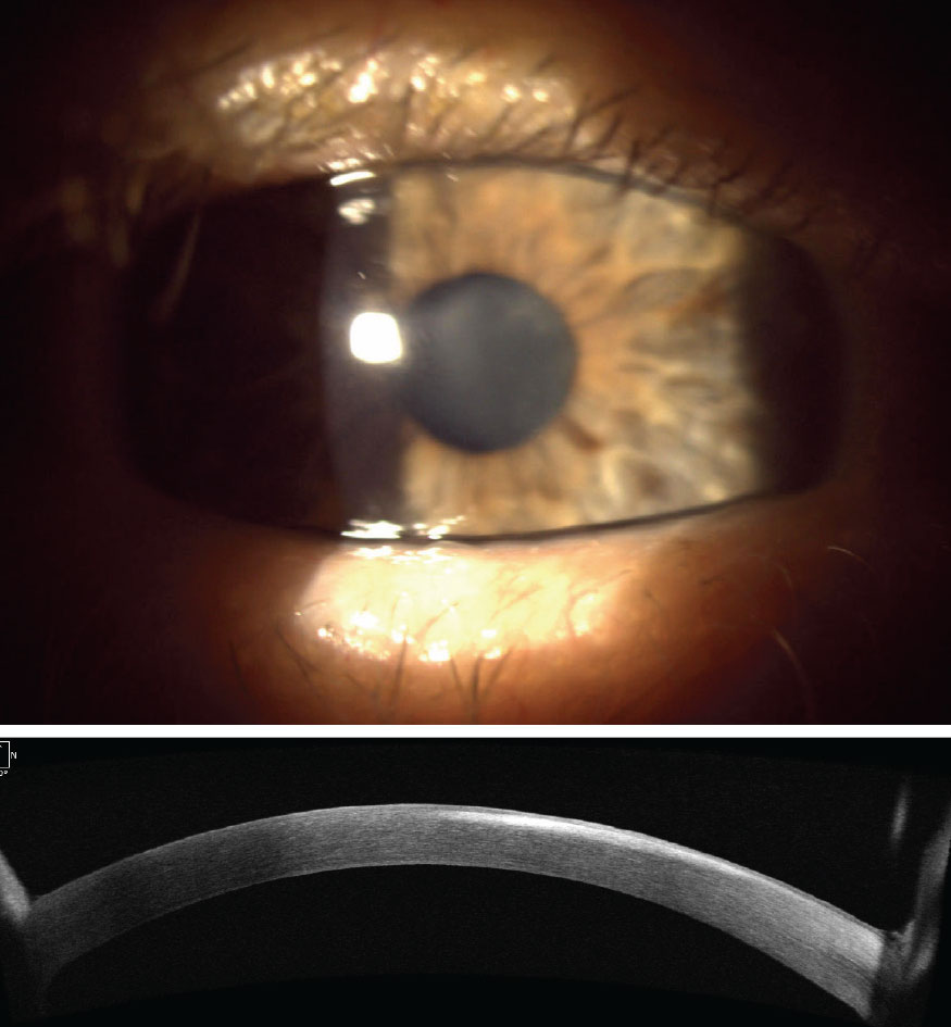 Fig. 2. Same patient from Figure 1 whose epithelial disease resolved with oral antivirals but progressed to stromal keratitis. Top photo shows central stromal haze which corresponds to hyperreflectivity on anterior segment OCT (bottom photo).