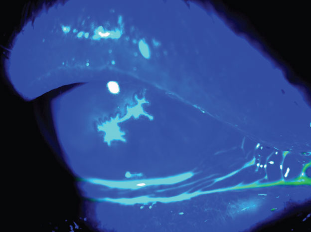 Fig. 1. Typical HSV keratitis epithelial dendrite with terminal bulbs.