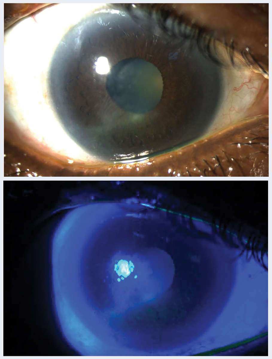 Fig. 1. (A) Neurotrophic keratitis in a 78-year-old woman with uncontrolled type 2 diabetes for 20 years, A1c 11%, proliferative diabetic retinopathy OU seen in white light and (B) under cobalt blue filter.