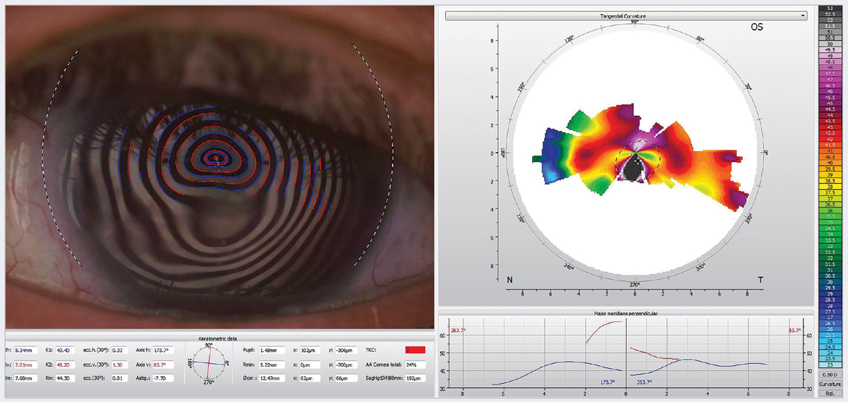 Fig. 2. Induced irregular astigmatism in a 70-year-old woman with neurotrophic keratitis. One treatment option for this patient is scleral contact lenses.