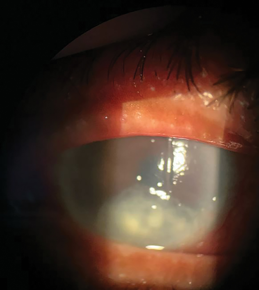 Fig. 3. Neurotrophic ulcer (stage 3 neurotrophic keratitis) in the right eye. There is an overlying epithelial defect with classic rolled edges in the inferior third of the cornea and underlying stromal haze.