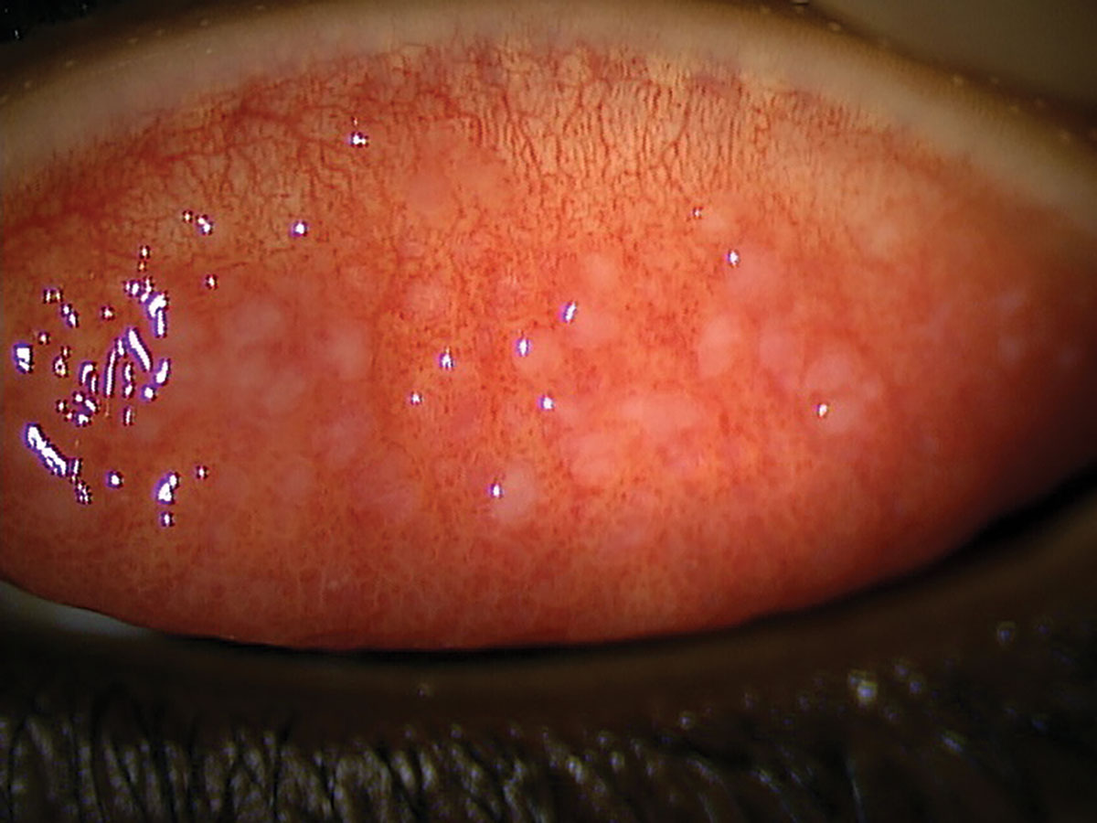 Fig. 1. Upper lid eversion of patient in case 1, showing giant papillae with scarred apices.