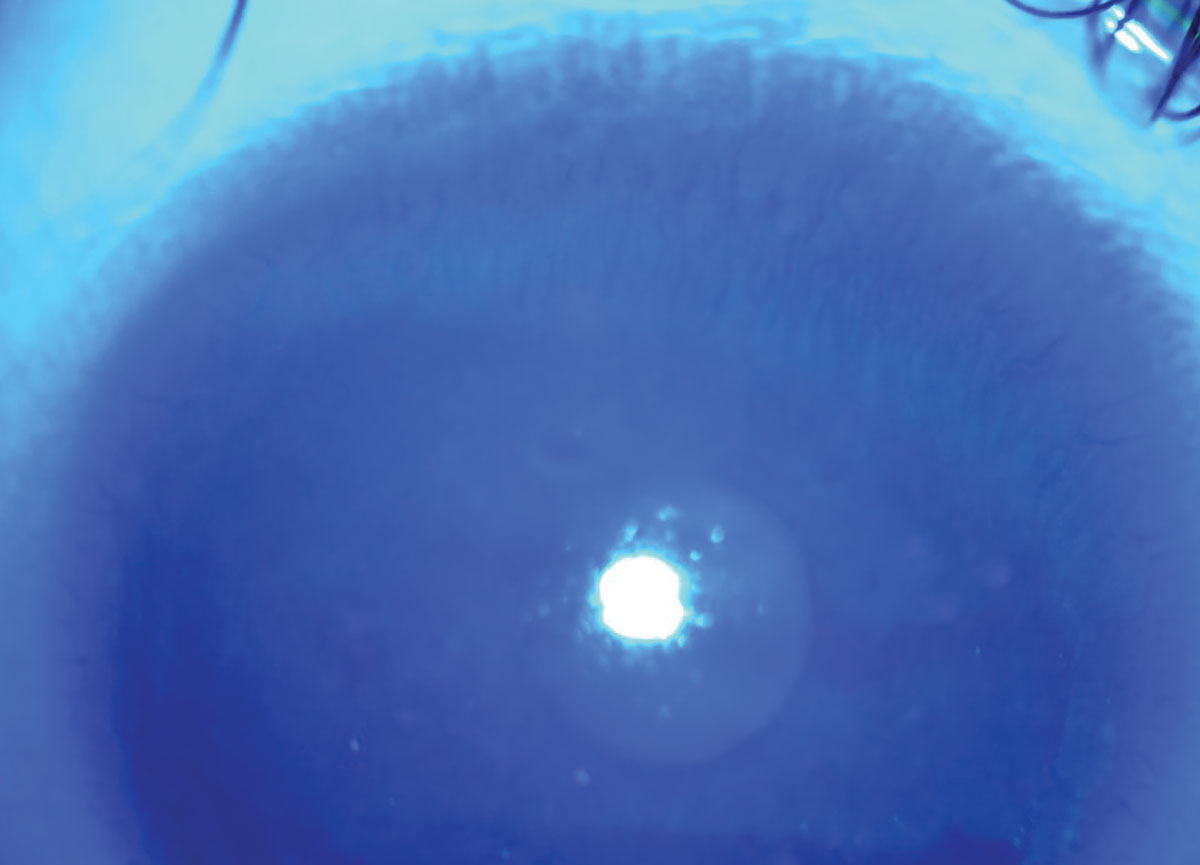 Fig. 2. Superior corneal appearance of patient in case 2, showing sawtooth staining pattern characteristic of limbal stem cell deficiency.