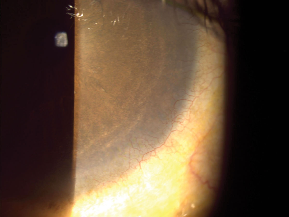 Fig. 3. Corneal neovascularization seen in the patient in case 3.