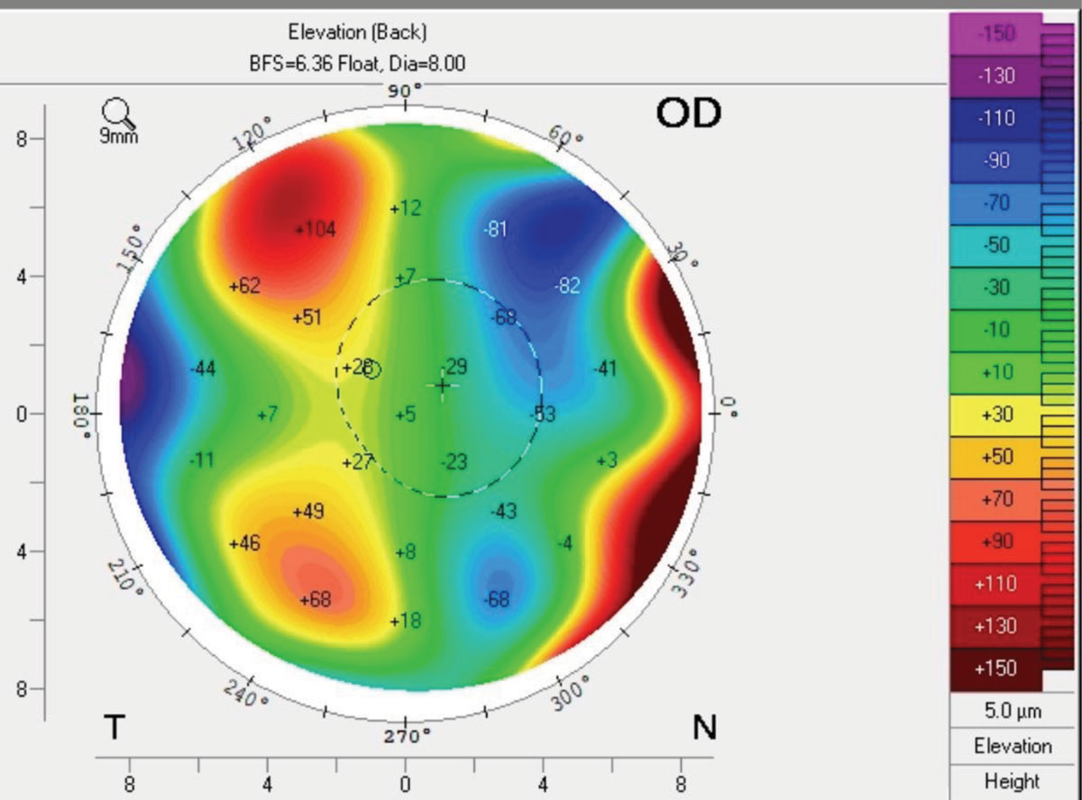 A patient with Fuch’s dystrophy showing focal areas of swelling superotemporal and inferotemporal.