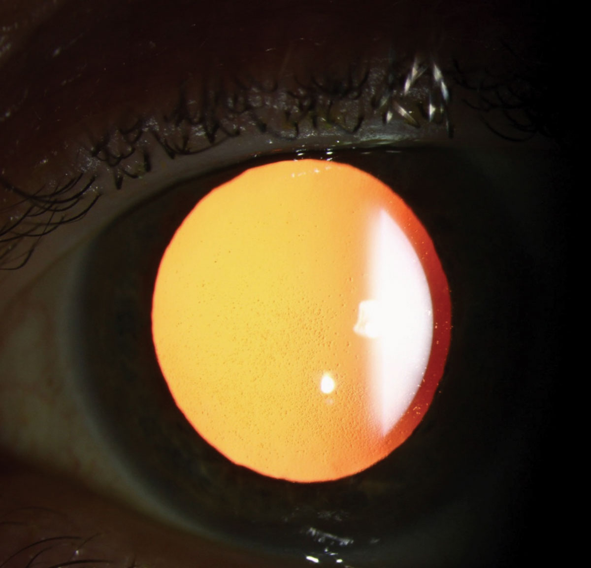 Retroillumination slit lamp photo showing corneal guttae.