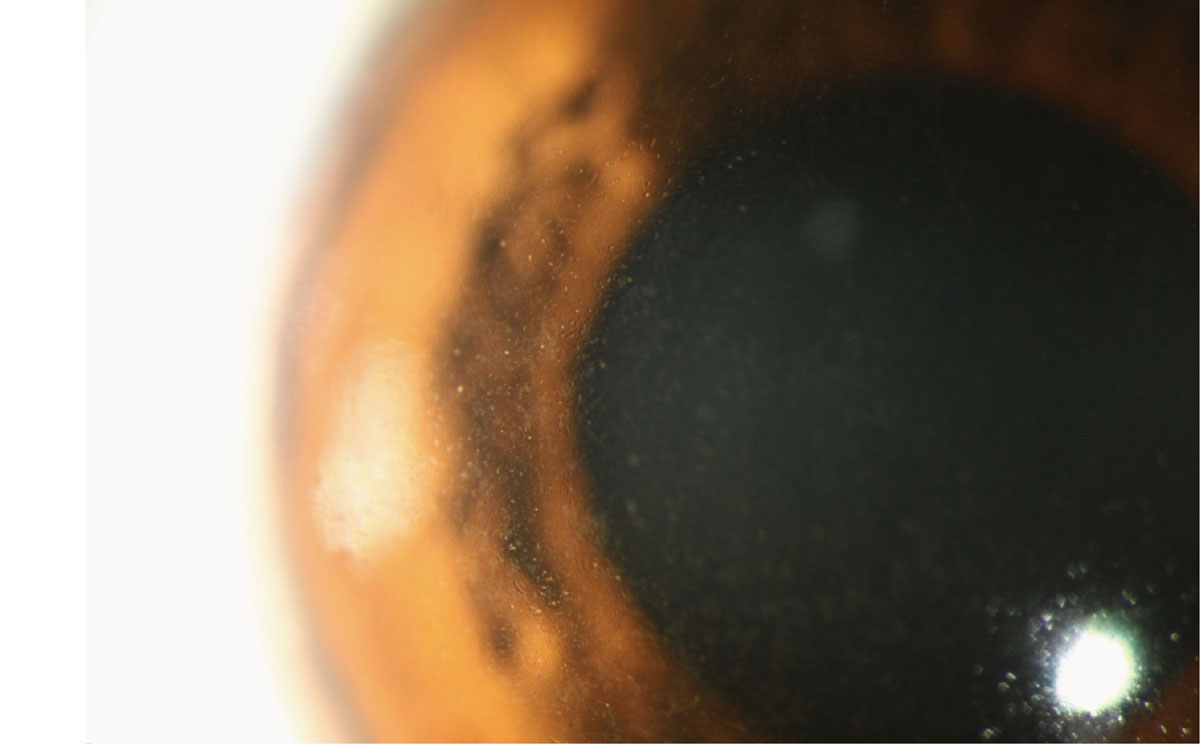 Retroillumination slit lamp photo showing corneal guttae.