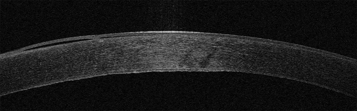 Anterior segment OCT shows the irregular corneal endothelium in a patient with Fuchs’ dystrophy.